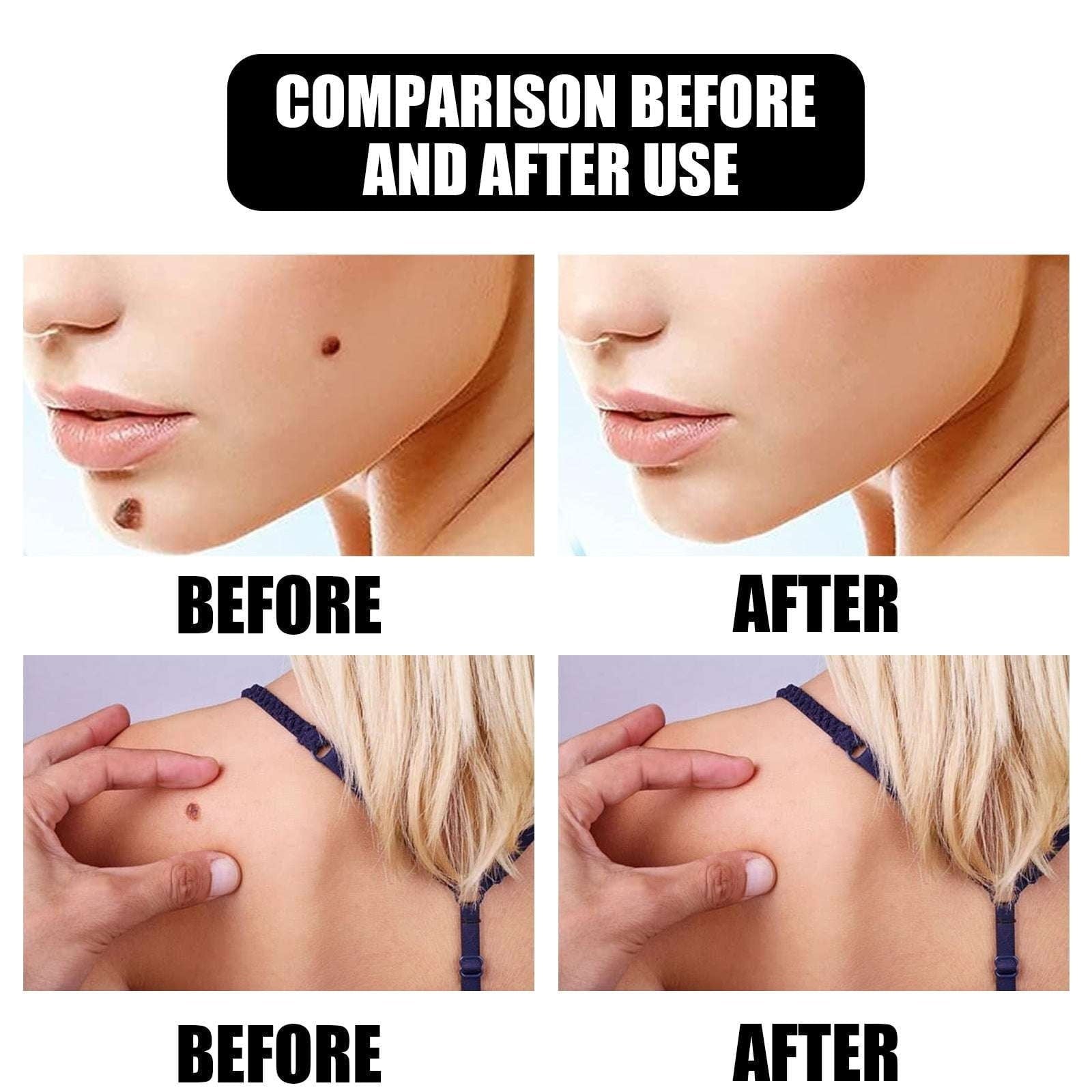 Armpit Removal, Neck Removal, Skin Removal - available at Sparq Mart